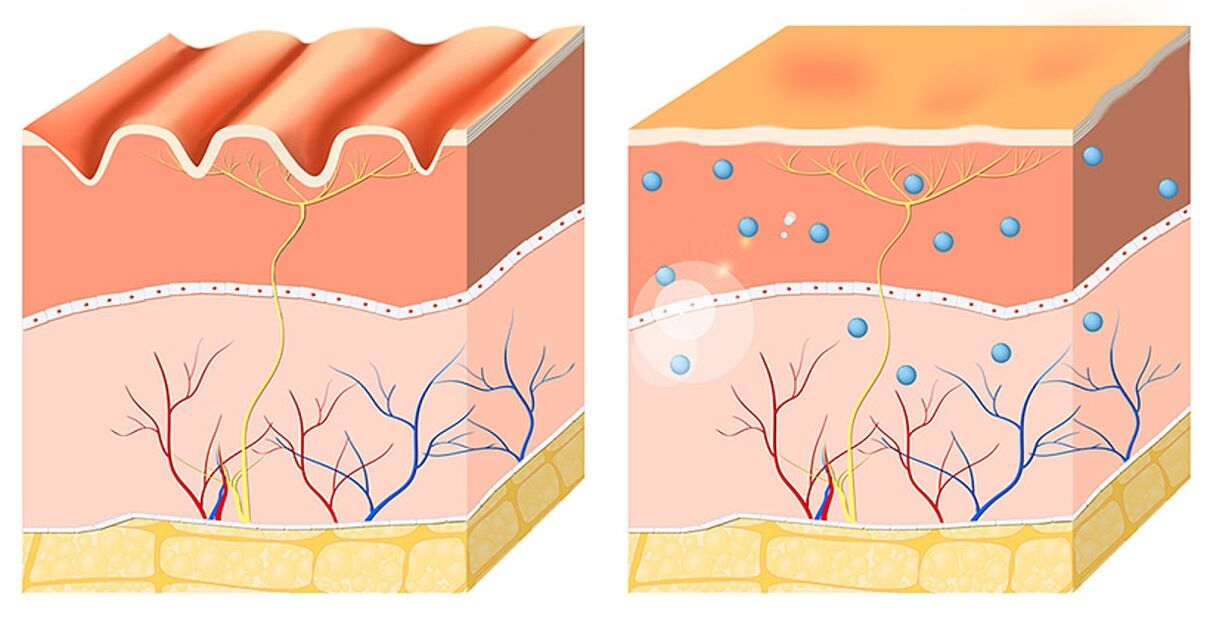 Inno Gialuron evens and moisturizes the epidermis