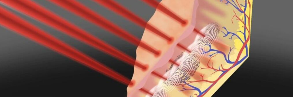 Rejuvenation of the field of the skin