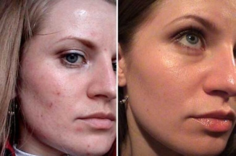 Correction of the quality of the skin