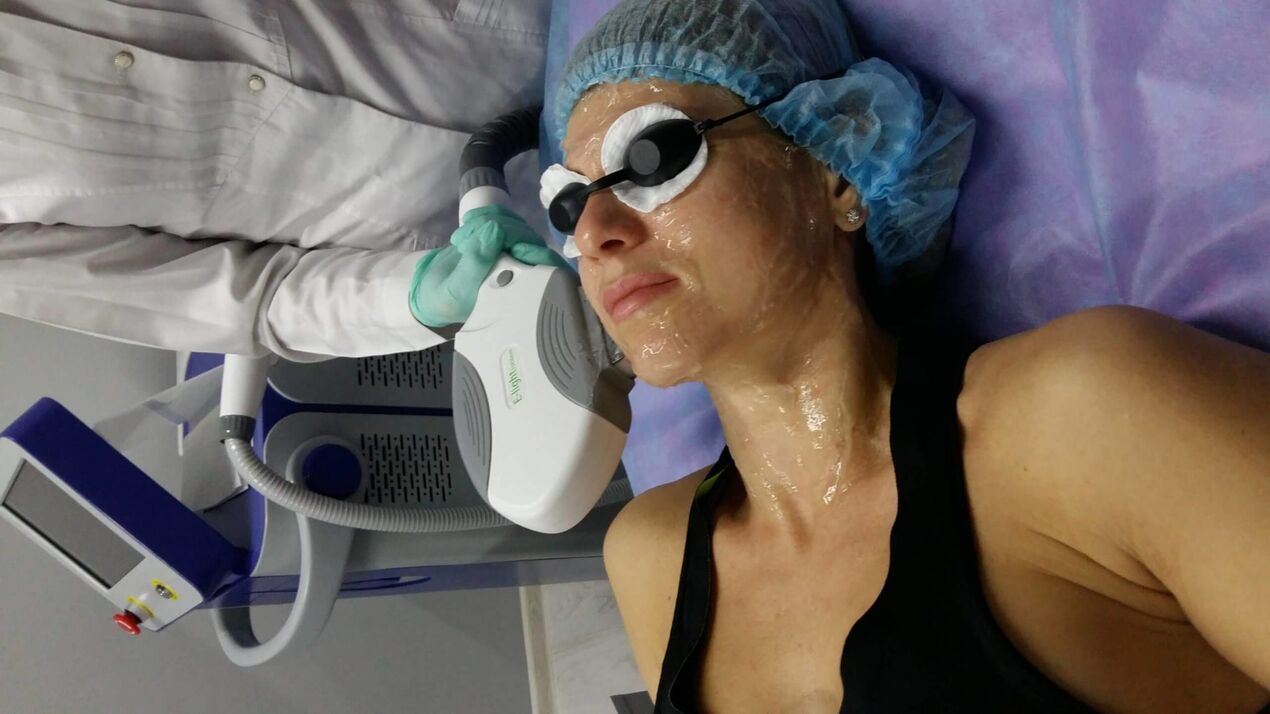 The use of a laser together with a gel for gentle skin rejuvenation