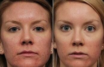 Face laser rejuvenation before and after