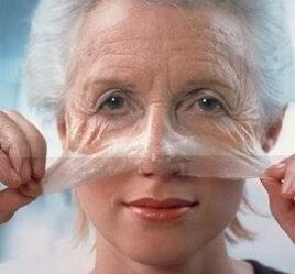 Face rejuvenation of the face with a laser