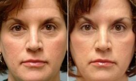 before and after the fractional rejuvenation procedure