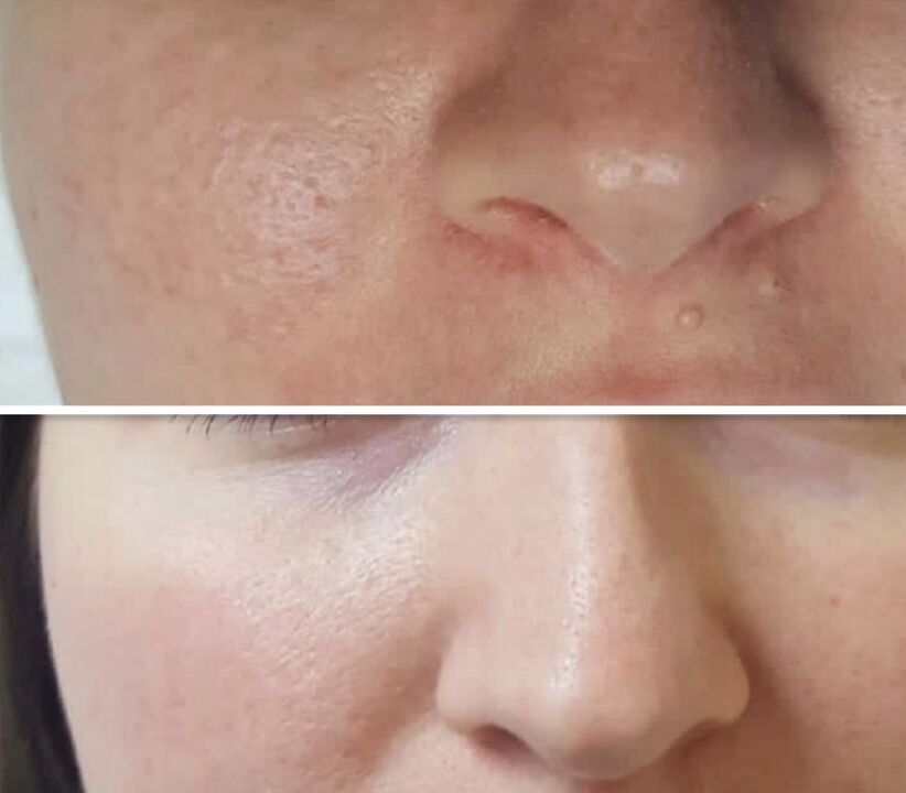 The result of fractional rejuvenation facial skin before and after the procedure